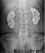 Medullary Nephrocalcinosis